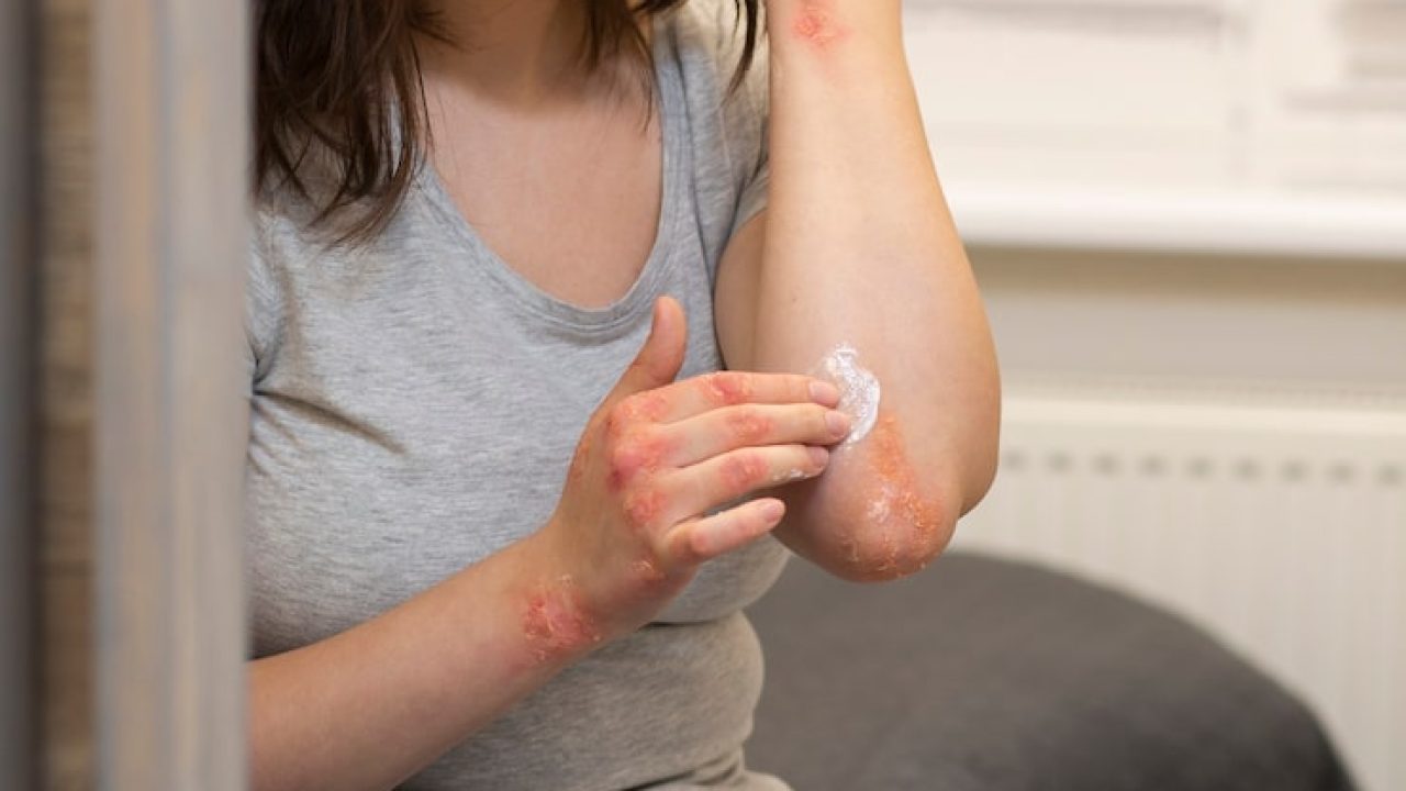 hands-patient-suffering-from-psoriasis_23-2149329686